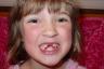Callie after getting her two bottom teeth pulled.